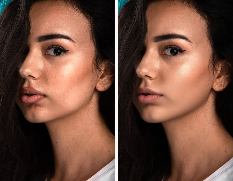 Flawless Acne Removal