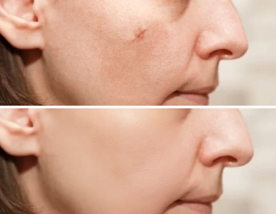 A close-up photo showing a facial scar being seamlessly removed by the AI blemish remover.